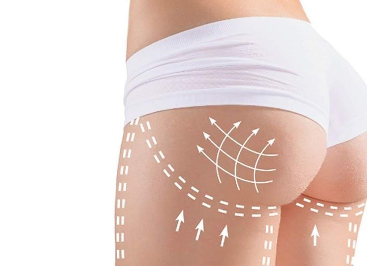 Injection des fesses