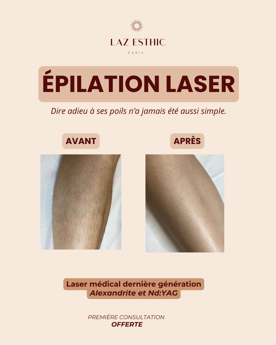 Épilation définitive