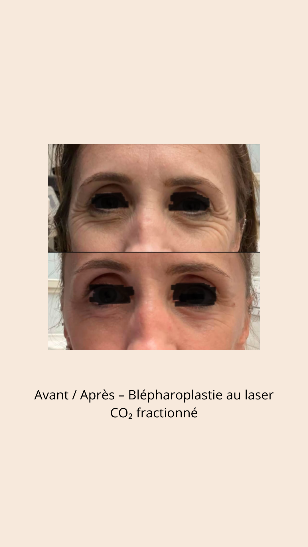 Avant / après 1
