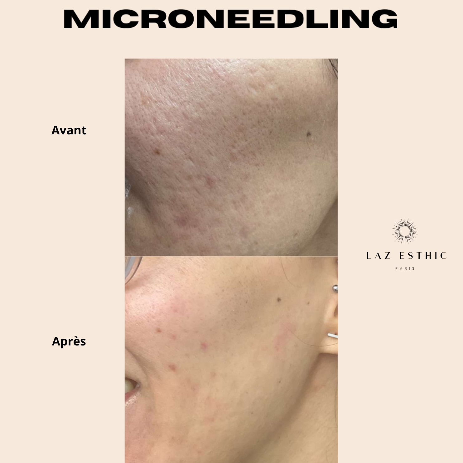 Microneedling