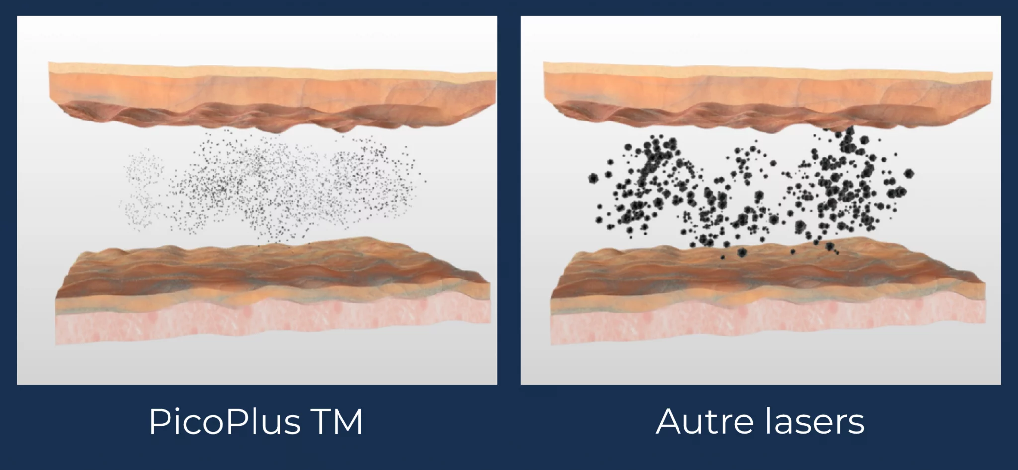 PicoPlus vs autres lasers